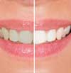 Teeth Whitening By Dr. Sindhu Gundabathula, DDS Dentist near Doylestown, Pennsylvania